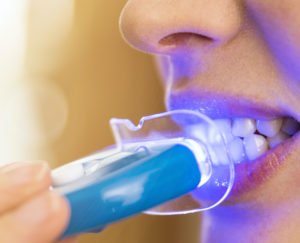 Ein Zahnbleaching eignet sich nicht für jeden Patienten.