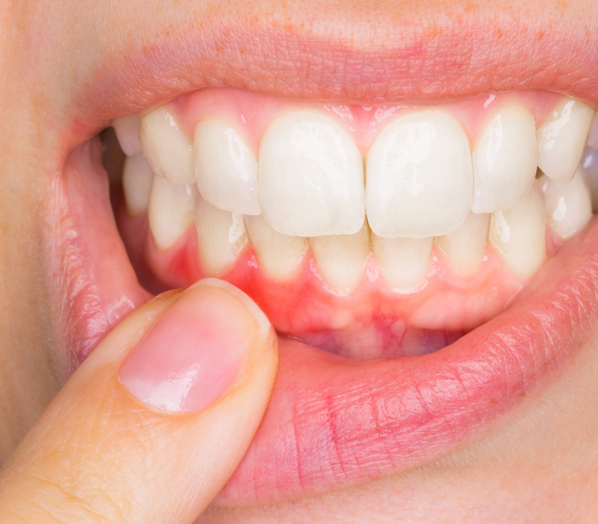Weiß Zahnfleck Radiergummi Zahnsteinentferner Polierer Zahnreinigung Zahnaufhellung Interdental Pick Mundhygiene 