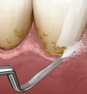 Der Zahnarzt entfernt mit speziellen Geräten und der richtigen Technik gehärteten Plaque.