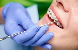 Einige Zahnzusatzversicherungen übernehmen kieferorthopädische Behandlungen bei Erwachsenen.