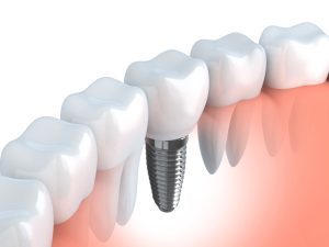 Zum Zahnersatz zählen Implantate, Kronen und Brücken.