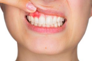 Eine unbehandelte Gingivitis kann zu Parodontose und Zahnverlust führen.