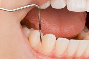 Eine professionelle Zahnreinigung beseitigt Zahnbeläge besonders gründlich.