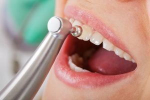 Wie hoch die Kosten für eine professionelle Zahnreinigung sind, hängt von verschiedenen Faktoren ab.