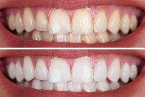 Im Vorher-Nachher-Vergleich sind die Zähne nach der PZR deutlich weißer.