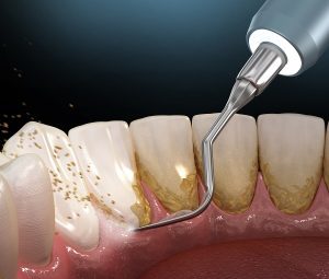 Bei einer professionellen Zahnreinigung entfernt der Zahnarzt Belege auf und zwischen den Zähnen.