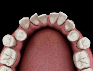 Sowohl im Kindes- als auch im Erwachsenenalter können Zahnfehlstellungen entstehen.