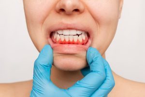 Kannst Du das Zahnfleischbluten nicht stoppen, solltest Du einen Zahnarzt aufsuchen.