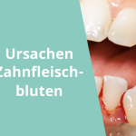 Zahnfleischbluten Ursachen