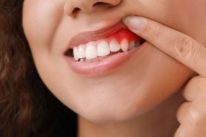 Eine häufige Ursache von Zahnfleischbluten ist eine Zahnfleischentzündung.