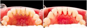 Zahnstein vorbeugen, vorher und nachher