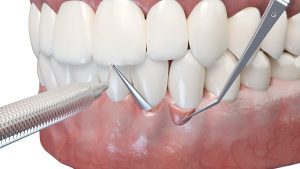 OP bei Zahnfleischrückgang