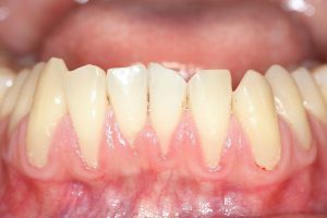 Zahnfleischrückgang durch Parodontose